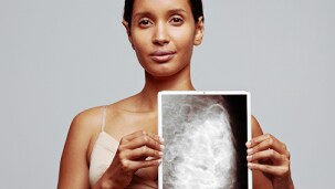 A woman holds up a mammogram of a dense breast.