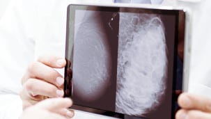 A mammogram image of a non-dense breast next to a mammogram image of a dense breast, demonstrating a clear difference.